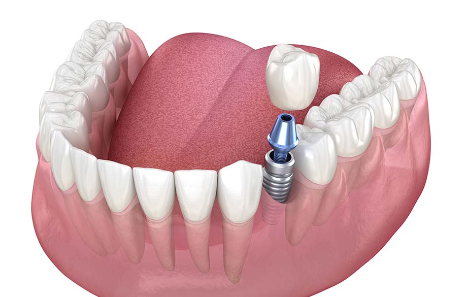 難症例にも対応高水準のインプラント治療