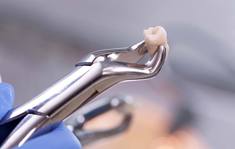 リラックスして受けられる親知らずの抜歯